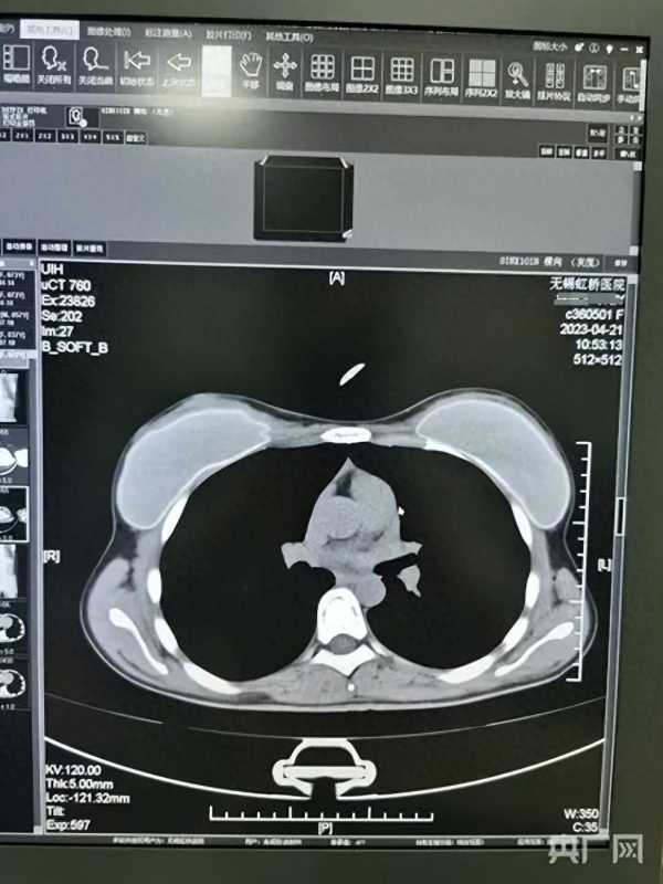 医院被举报骗保:1张CT片套多个病历